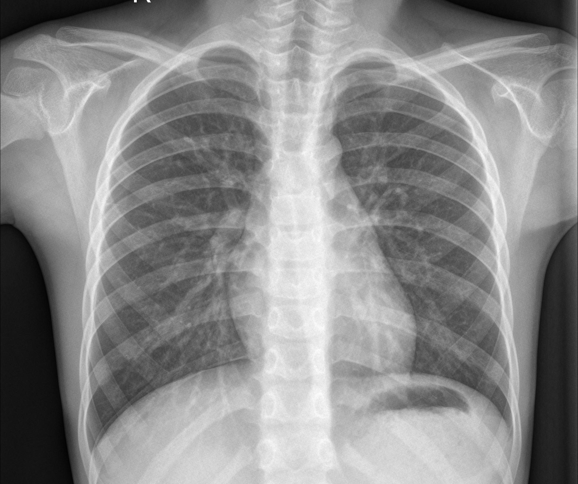 Pediatric Pnuemonia xray